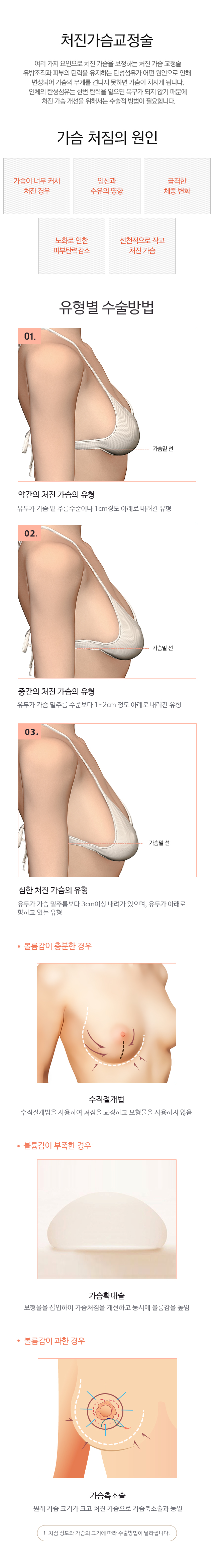 내시경 가슴성형