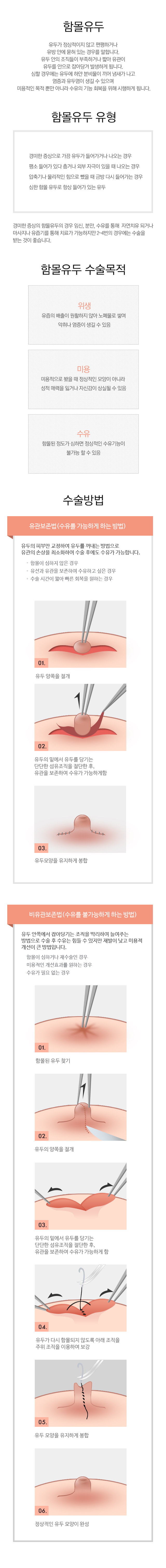 함몰유두